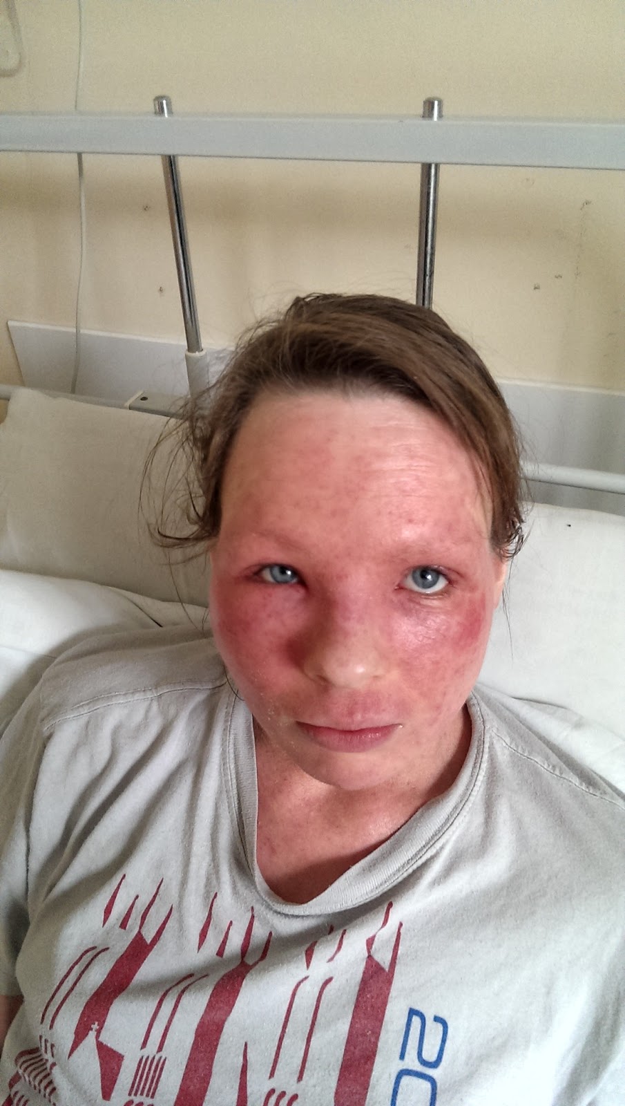 I Have Eczema Hospitalised with Eczema Herpeticum and Periorbital
